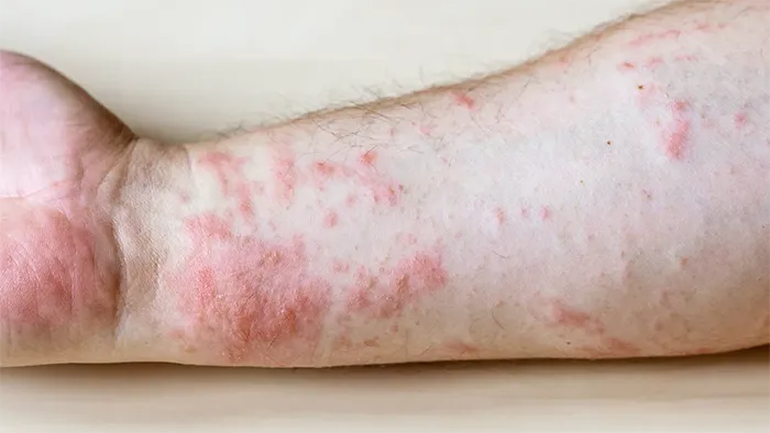skin-rash